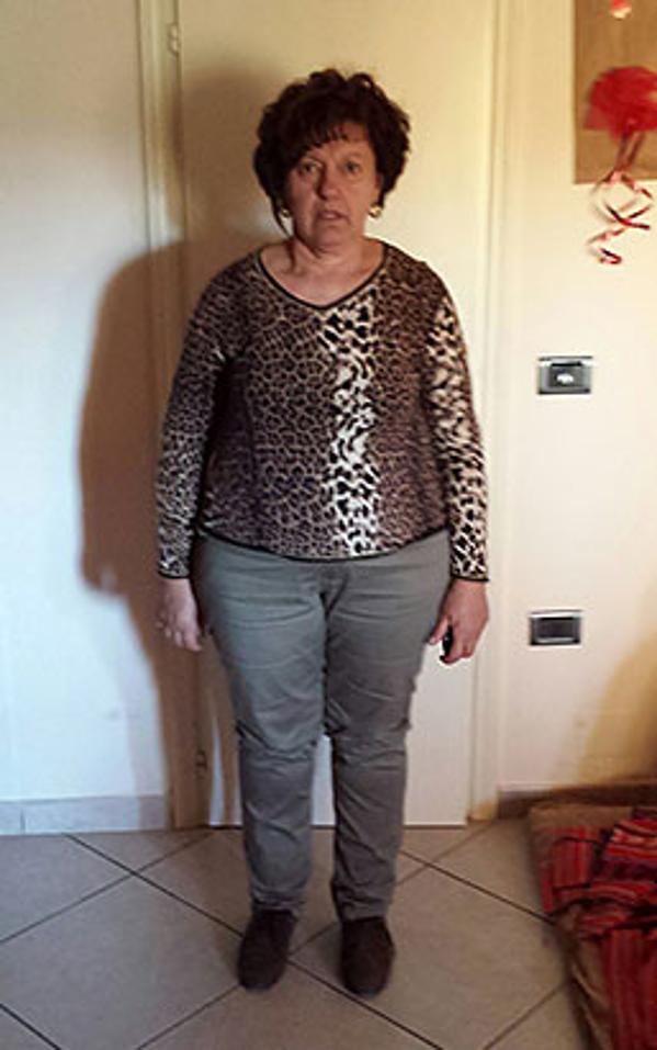 Antonietta Gasperoni prima della dieta Bioimis