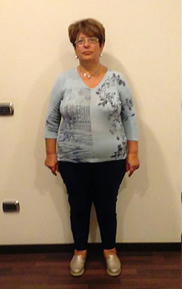 Maria Scavo prima della dieta Bioimis